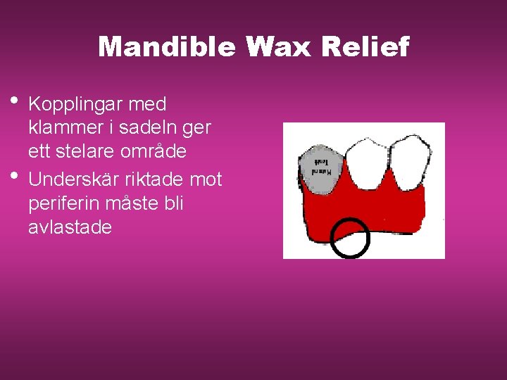 Mandible Wax Relief • Kopplingar med • klammer i sadeln ger ett stelare område