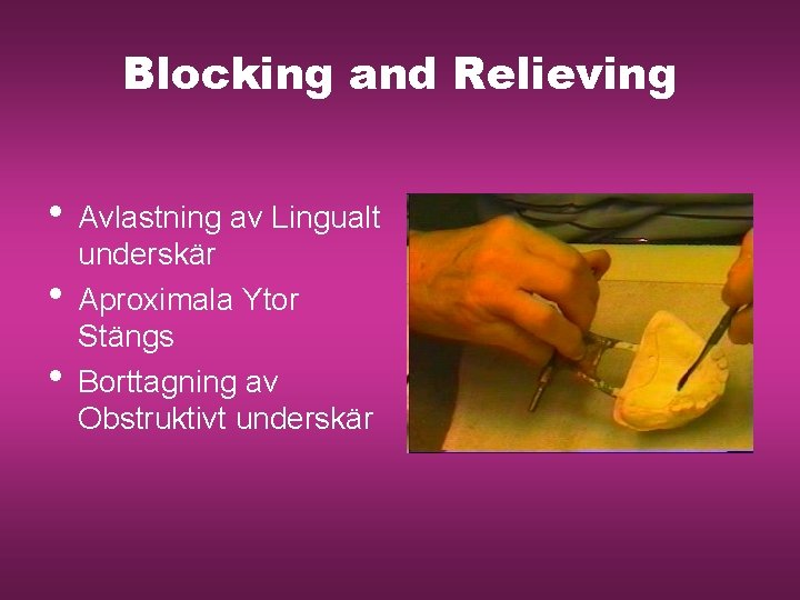 Blocking and Relieving • Avlastning av Lingualt • • underskär Aproximala Ytor Stängs Borttagning