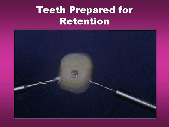 Teeth Prepared for Retention 