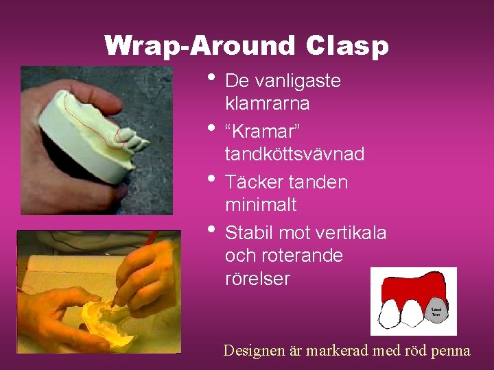 Wrap-Around Clasp • De vanligaste • • • klamrarna “Kramar” tandköttsvävnad Täcker tanden minimalt