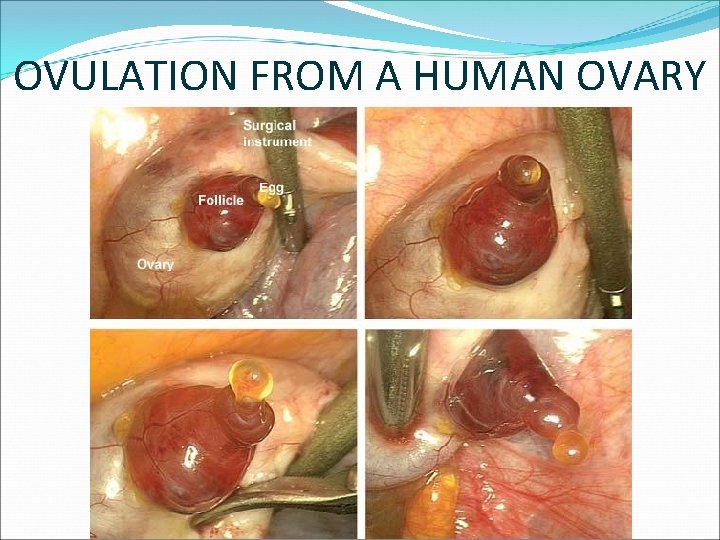 OVULATION FROM A HUMAN OVARY 