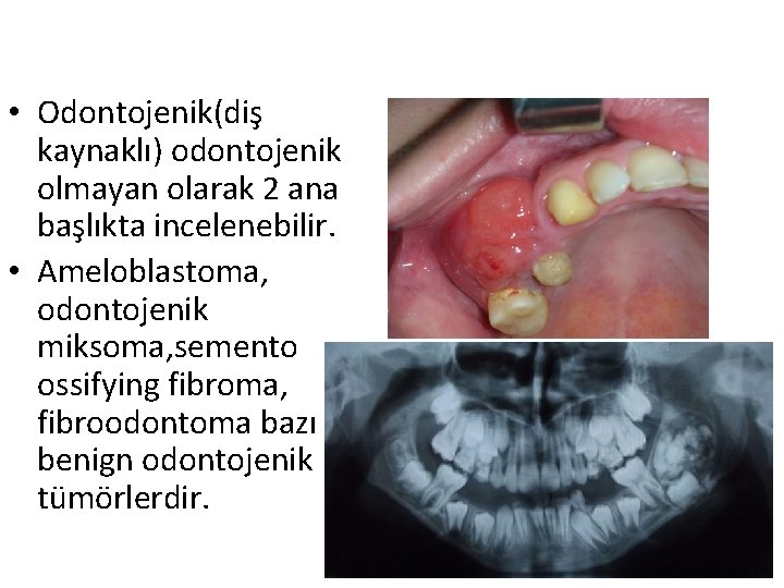  • Odontojenik(diş kaynaklı) odontojenik olmayan olarak 2 ana başlıkta incelenebilir. • Ameloblastoma, odontojenik