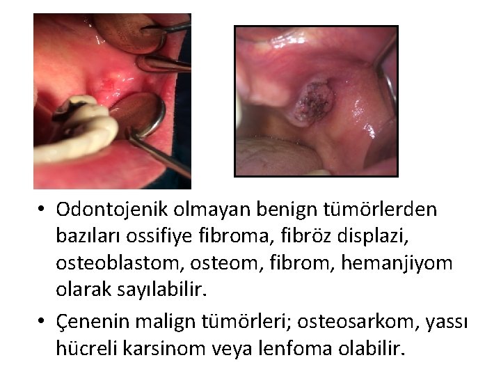  • Odontojenik olmayan benign tümörlerden bazıları ossifiye fibroma, fibröz displazi, osteoblastom, osteom, fibrom,