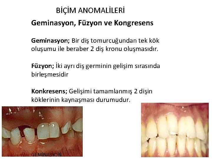 BİÇİM ANOMALİLERİ Geminasyon, Füzyon ve Kongresens Geminasyon; Bir diş tomurcuğundan tek kök oluşumu ile