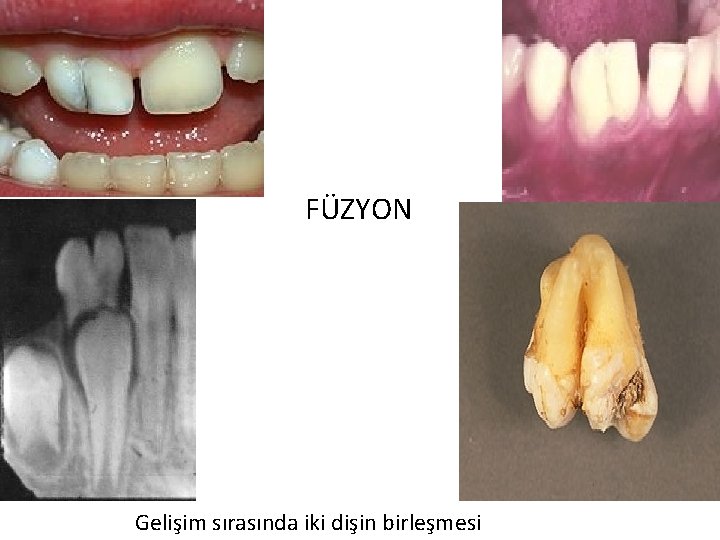 FÜZYON Gelişim sırasında iki dişin birleşmesi 15 