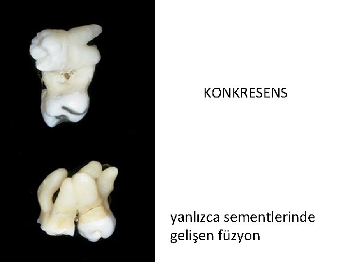 KONKRESENS yanlızca sementlerinde gelişen füzyon 16 