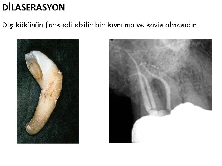 DİLASERASYON Diş kökünün fark edilebilir bir kıvrılma ve kavis almasıdır. 17 