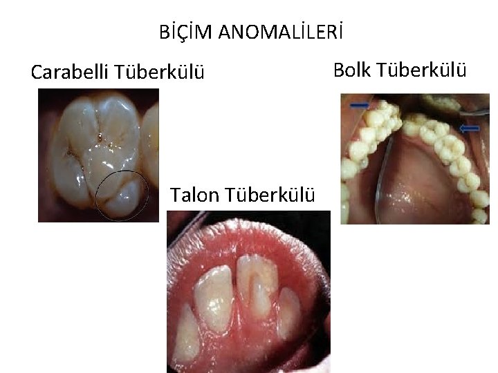 BİÇİM ANOMALİLERİ Carabelli Tüberkülü Talon Tüberkülü Bolk Tüberkülü 