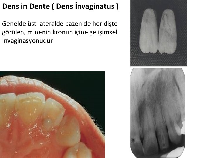 Dens in Dente ( Dens İnvaginatus ) Genelde üst lateralde bazen de her dişte