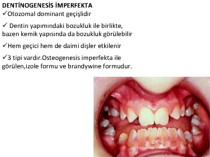 DENTİNOGENESİS İMPERFEKTA üOtozomal dominant geçişlidir ü Dentin yapımındaki bozukluk ile birlikte, bazen kemik yapısında