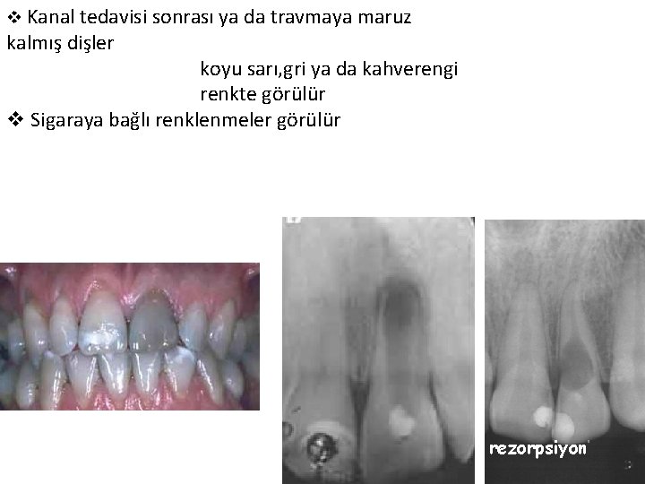 v Kanal tedavisi sonrası ya da travmaya maruz kalmış dişler koyu sarı, gri ya