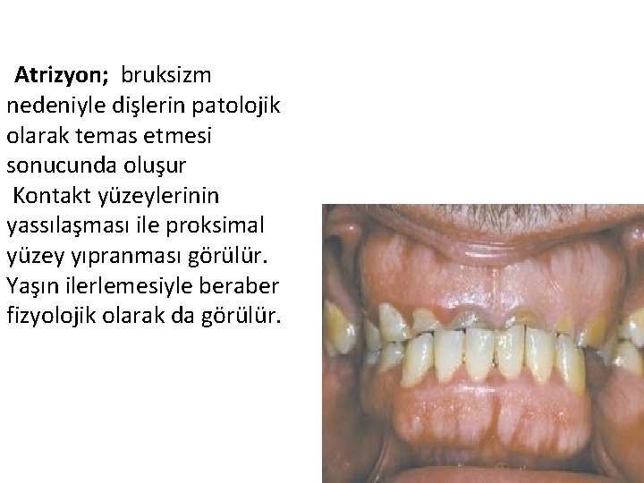 Atrizyon; bruksizm nedeniyle dişlerin patolojik olarak temas etmesi sonucunda oluşur Kontakt yüzeylerinin yassılaşması ile