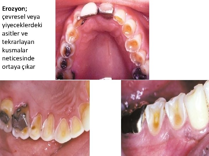 Erozyon; çevresel veya yiyeceklerdeki asitler ve tekrarlayan kusmalar neticesinde ortaya çıkar 27 