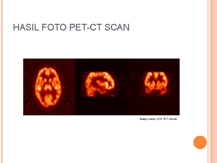 HASIL FOTO PET-CT SCAN 