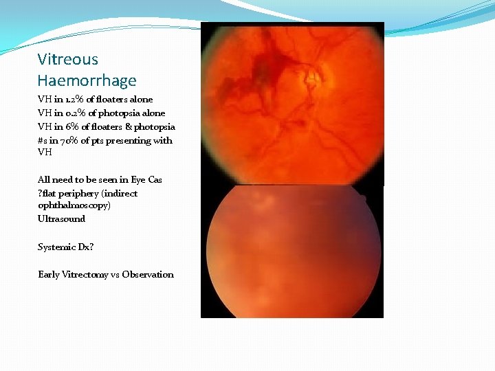 Vitreous Haemorrhage VH in 1. 2% of floaters alone VH in 0. 2% of