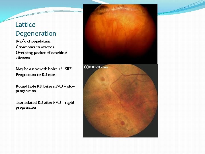 Lattice Degeneration 8 -10% of population Commoner in myopes Overlying pocket of synchitic vitreous
