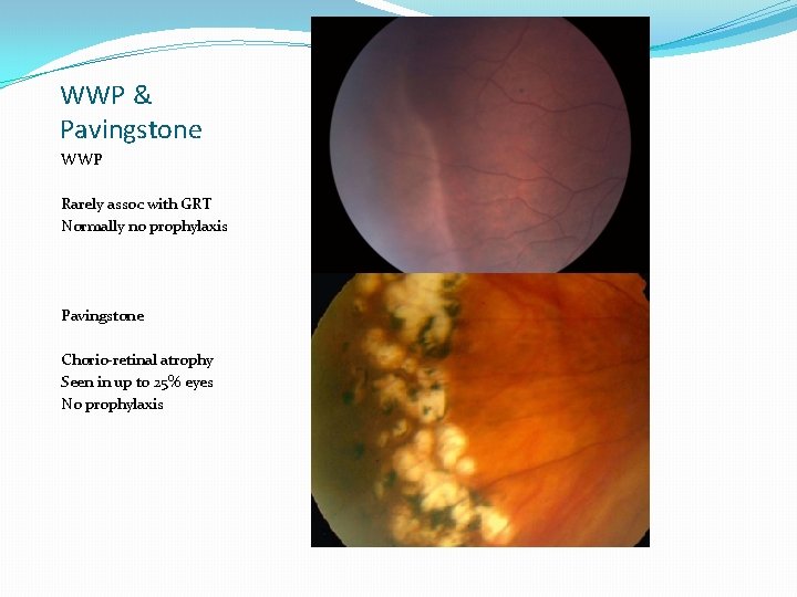 WWP & Pavingstone WWP Rarely assoc with GRT Normally no prophylaxis Pavingstone Chorio-retinal atrophy