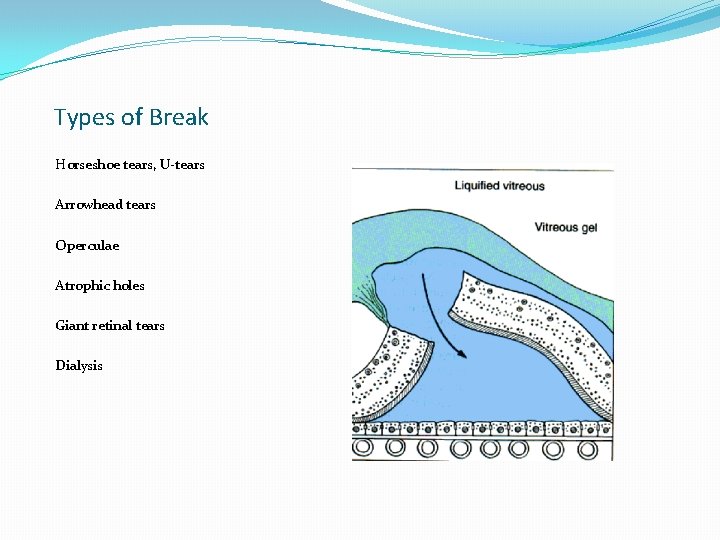 Types of Break Horseshoe tears, U-tears Arrowhead tears Operculae Atrophic holes Giant retinal tears