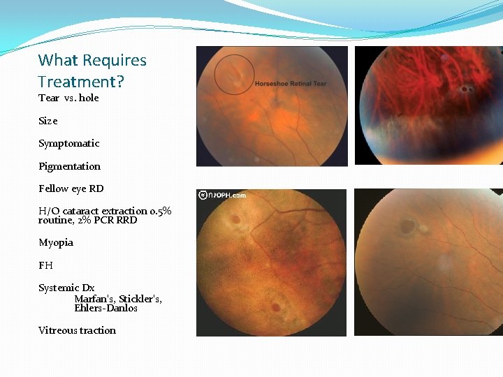 What Requires Treatment? Tear vs. hole Size Symptomatic Pigmentation Fellow eye RD H/O cataract