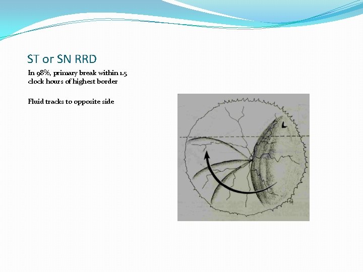ST or SN RRD In 98%, primary break within 1. 5 clock hours of