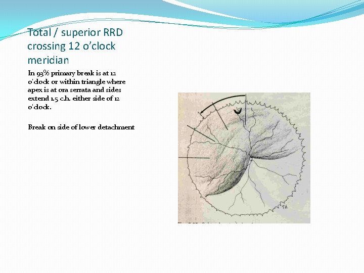 Total / superior RRD crossing 12 o’clock meridian In 93% primary break is at