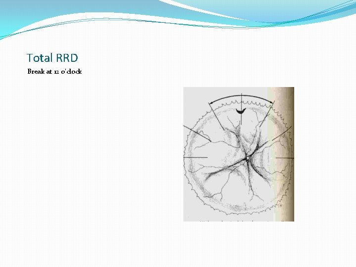 Total RRD Break at 12 o’clock 