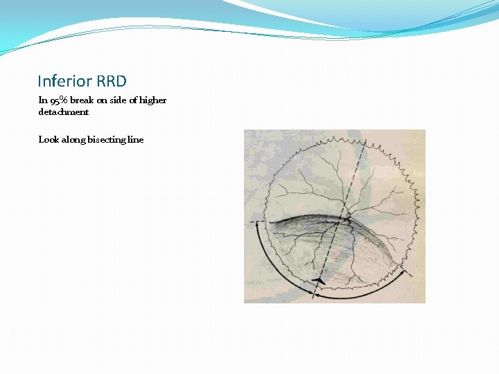 Inferior RRD In 95% break on side of higher detachment Look along bisecting line
