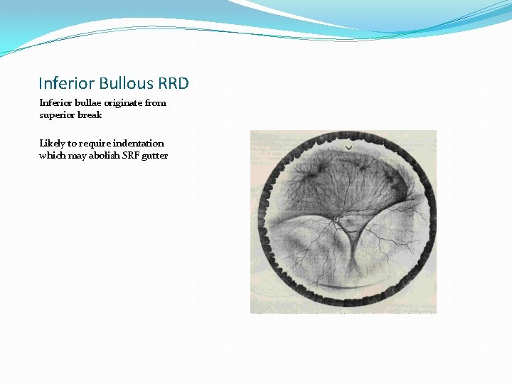 Inferior Bullous RRD Inferior bullae originate from superior break Likely to require indentation which