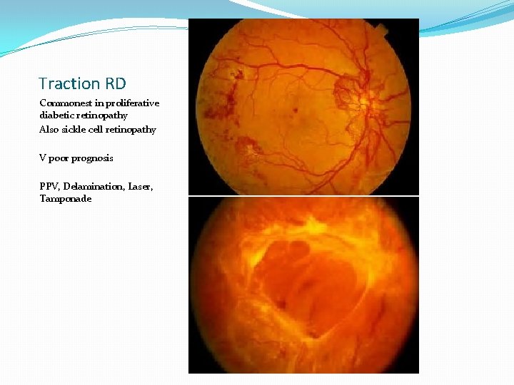 Traction RD Commonest in proliferative diabetic retinopathy Also sickle cell retinopathy V poor prognosis