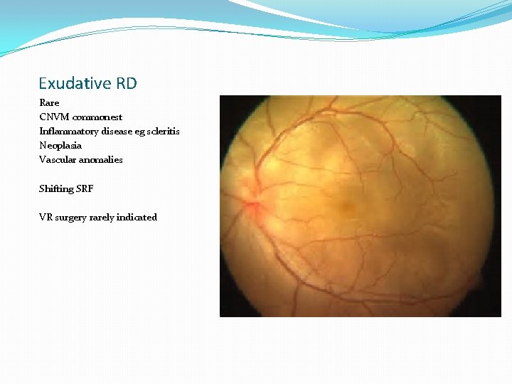 Exudative RD Rare CNVM commonest Inflammatory disease eg scleritis Neoplasia Vascular anomalies Shifting SRF