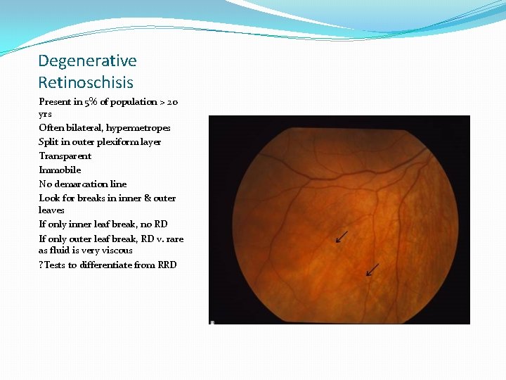 Degenerative Retinoschisis Present in 5% of population > 20 yrs Often bilateral, hypermetropes Split