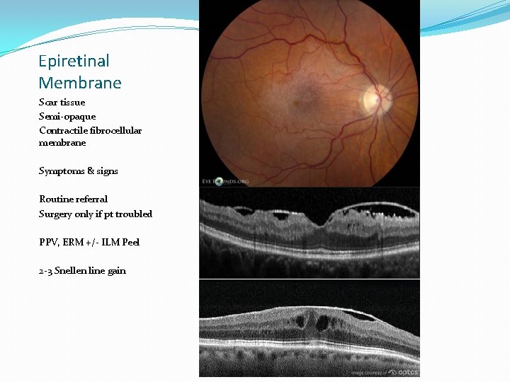 Epiretinal Membrane Scar tissue Semi-opaque Contractile fibrocellular membrane Symptoms & signs Routine referral Surgery