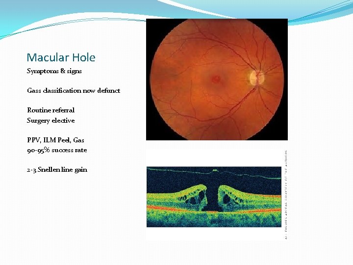 Macular Hole Symptoms & signs Gass classification now defunct Routine referral Surgery elective PPV,