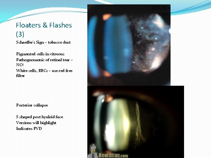 Floaters & Flashes (3) Schaeffer’s Sign – tobacco dust Pigmented cells in vitreous Pathognomonic