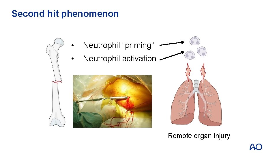 Second hit phenomenon • Neutrophil “priming” • Neutrophil activation Remote organ injury Second hit phenomenon • Neutrophil “priming” • Neutrophil activation Remote organ injury