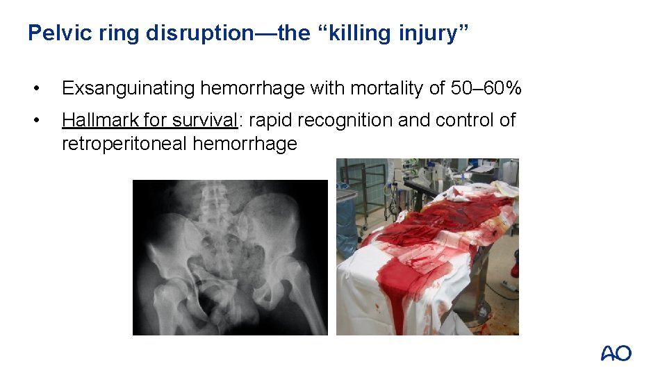 Pelvic ring disruption—the “killing injury” • Exsanguinating hemorrhage with mortality of 50– 60% • Pelvic ring disruption—the “killing injury” • Exsanguinating hemorrhage with mortality of 50– 60% •