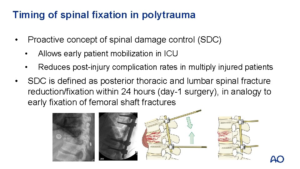 Timing of spinal fixation in polytrauma • • Proactive concept of spinal damage control Timing of spinal fixation in polytrauma • • Proactive concept of spinal damage control