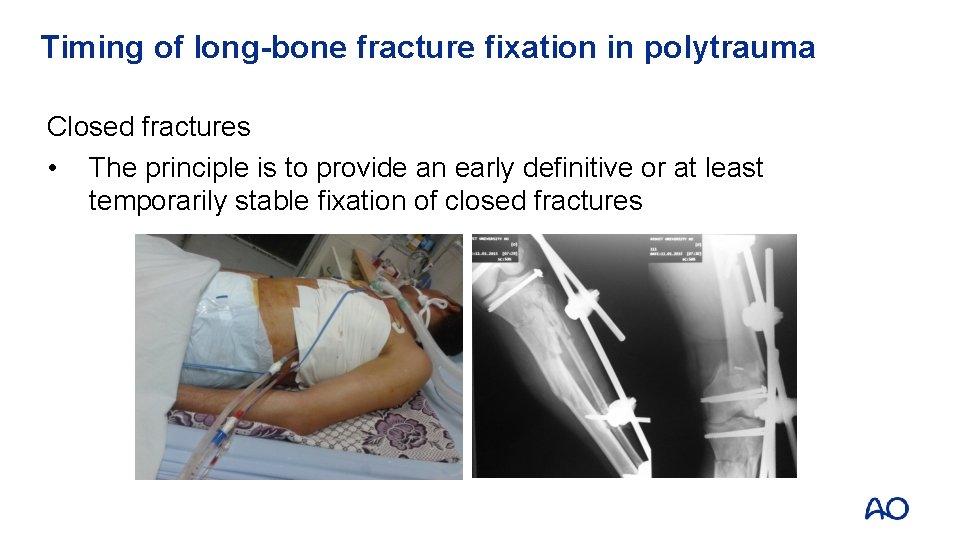 Timing of long-bone fracture fixation in polytrauma Closed fractures • The principle is to Timing of long-bone fracture fixation in polytrauma Closed fractures • The principle is to