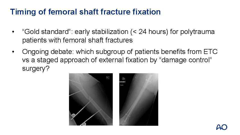 Timing of femoral shaft fracture fixation • “Gold standard”: early stabilization (< 24 hours) Timing of femoral shaft fracture fixation • “Gold standard”: early stabilization (< 24 hours)