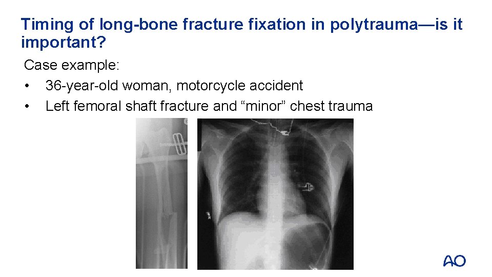 Timing of long-bone fracture fixation in polytrauma—is it important? Case example: • 36 -year-old Timing of long-bone fracture fixation in polytrauma—is it important? Case example: • 36 -year-old