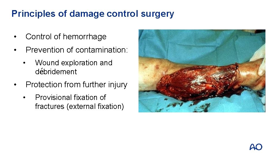 Principles of damage control surgery • Control of hemorrhage • Prevention of contamination: • Principles of damage control surgery • Control of hemorrhage • Prevention of contamination: •
