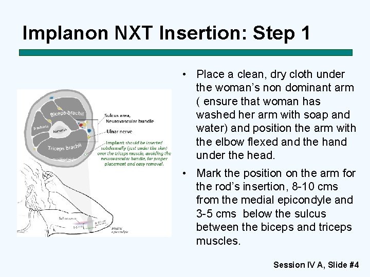 Implanon NXT Insertion: Step 1 • Place a clean, dry cloth under the woman’s