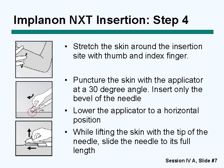 Implanon NXT Insertion: Step 4 • Stretch the skin around the insertion site with