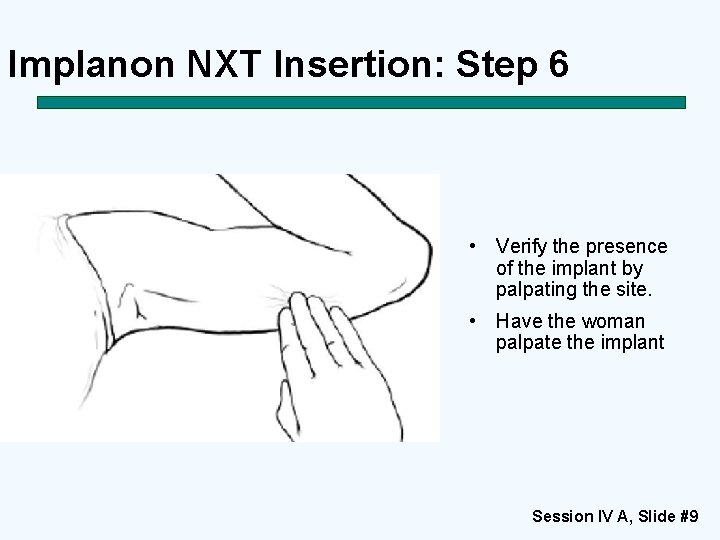 Implanon NXT Insertion: Step 6 • Verify the presence of the implant by palpating