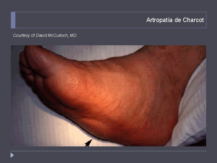 Artropatía de Charcot Courtesy of David Mc. Culloch, MD. 