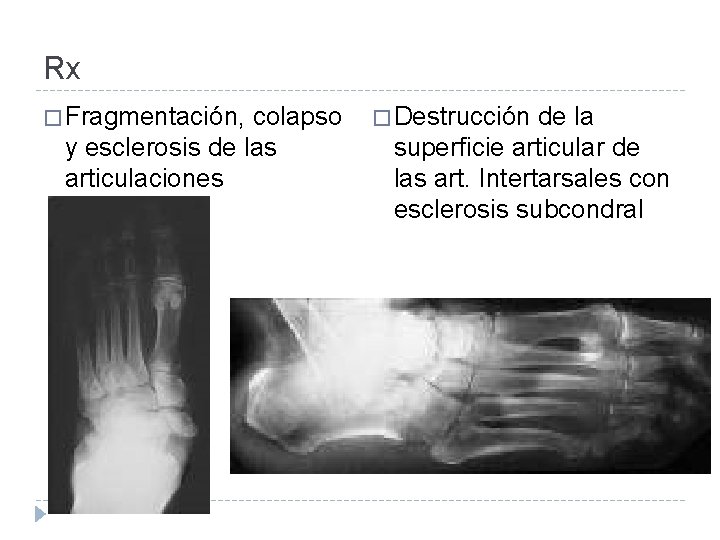 Rx � Fragmentación, colapso y esclerosis de las articulaciones intertarsales � Destrucción de la