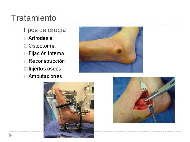 Tratamiento � Tipos de cirugía: � Artrodesis � Osteotomía � Fijación interna � Reconstrucción