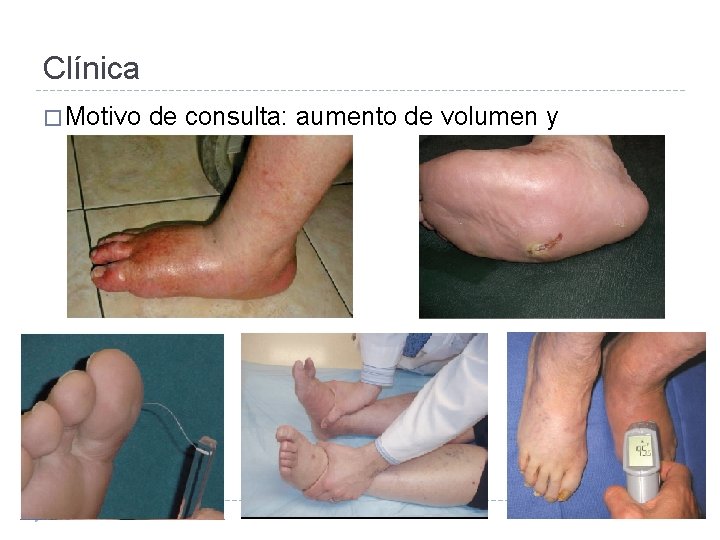 Clínica � Motivo de consulta: aumento de volumen y deformidad. 