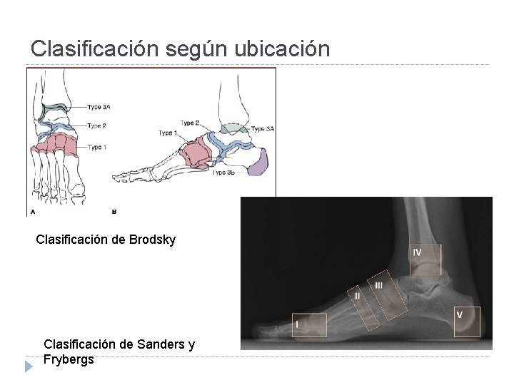 Clasificación según ubicación Clasificación de Brodsky Clasificación de Sanders y Frybergs 