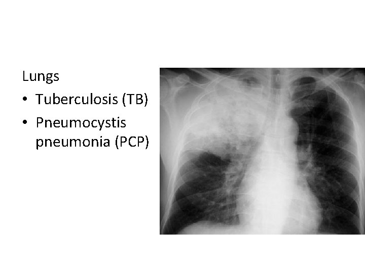 Lungs • Tuberculosis (TB) • Pneumocystis pneumonia (PCP) 